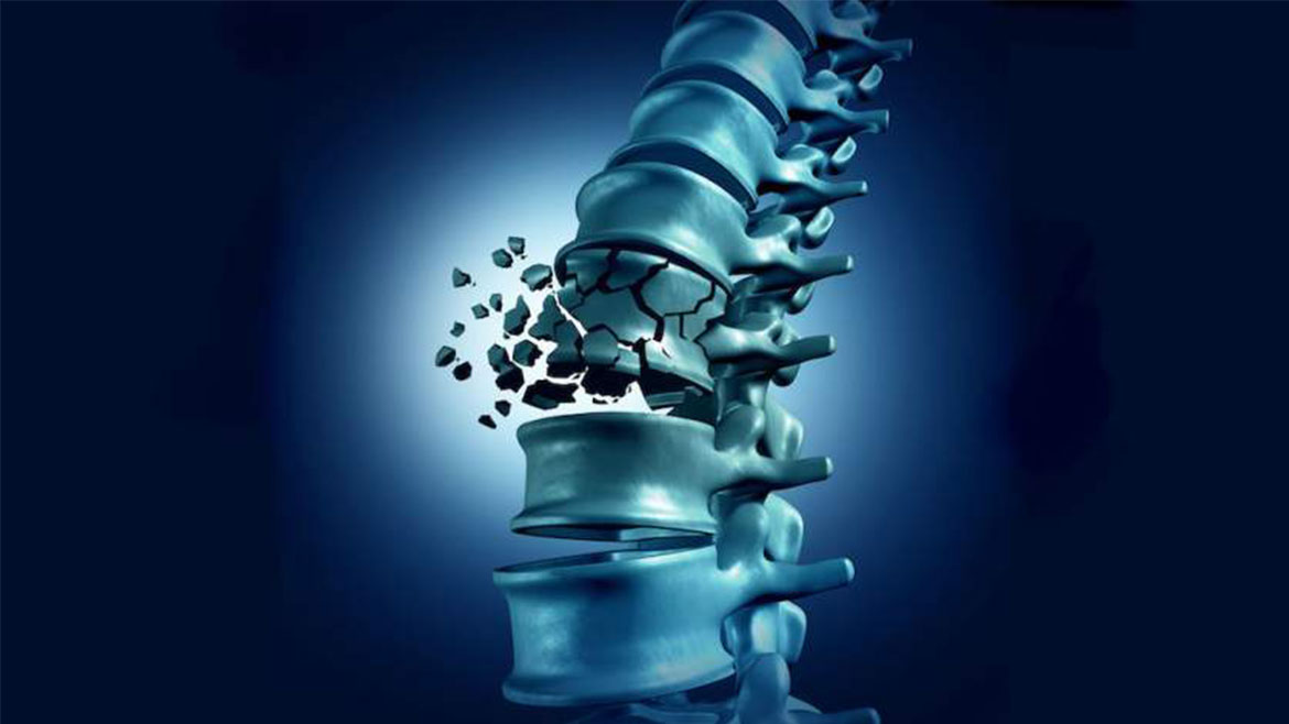 Omurga Kırıklıkları