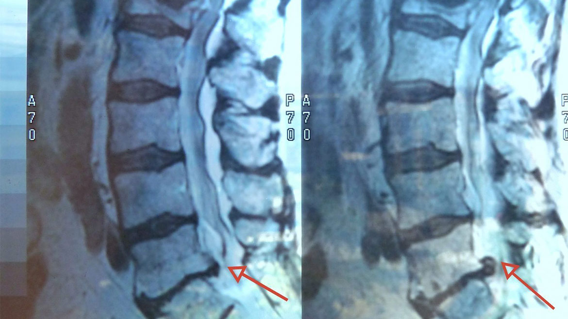 Omurilik Kanalında Daralma