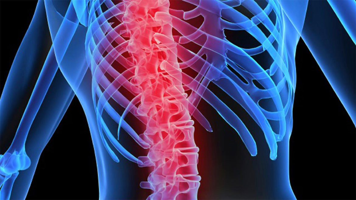 Omurilik Tümörleri